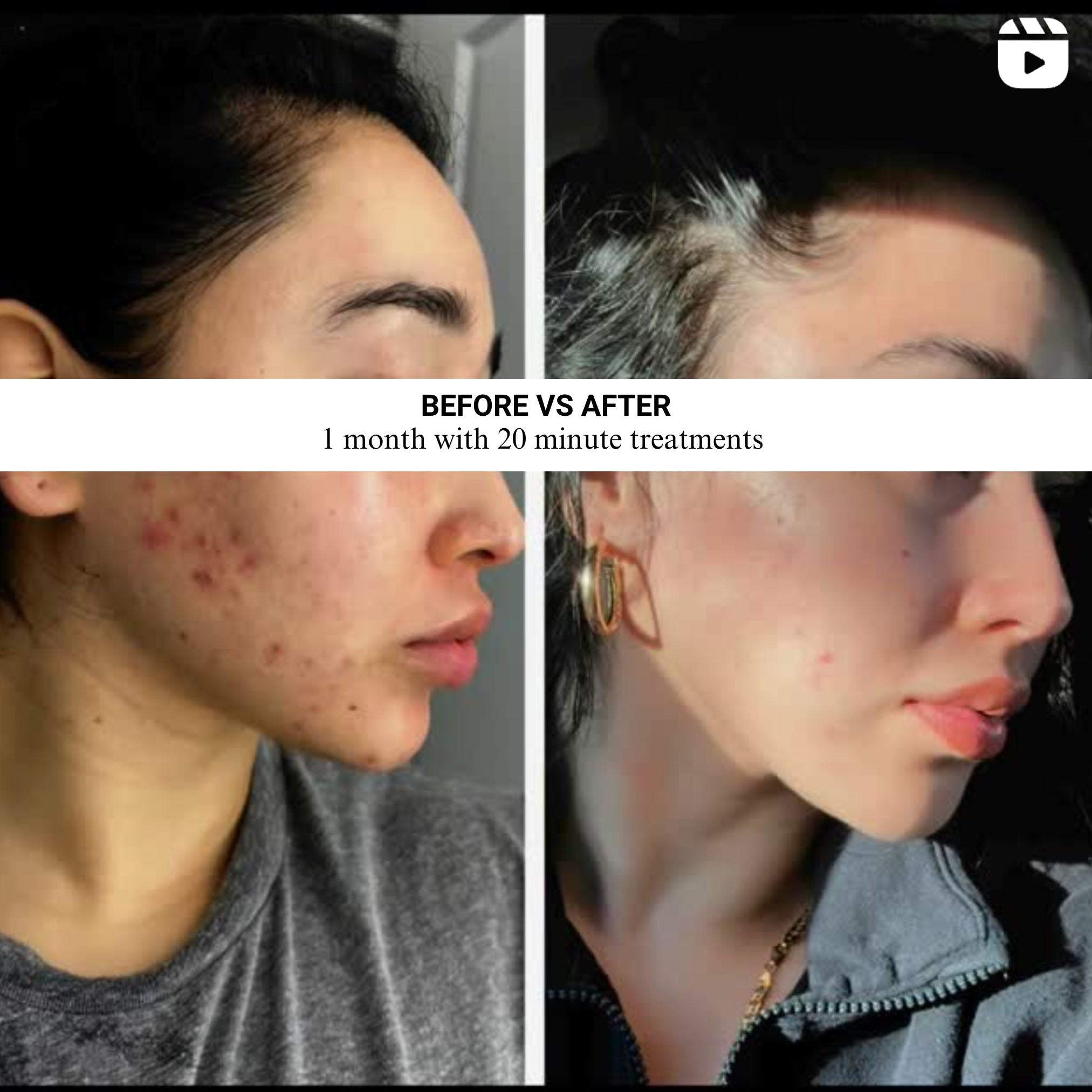 VISO by Lumara | FDA Certified Red Light Therapy Mask